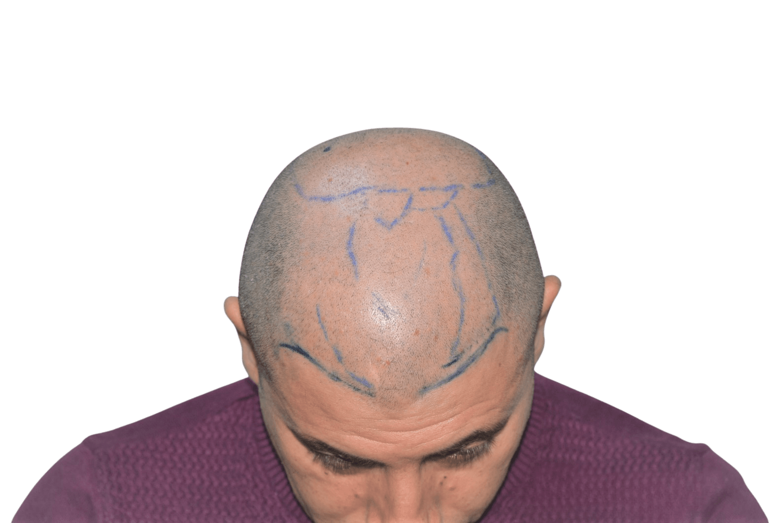 Before treatment top-down view showing marked thinning across the crown and central scalp